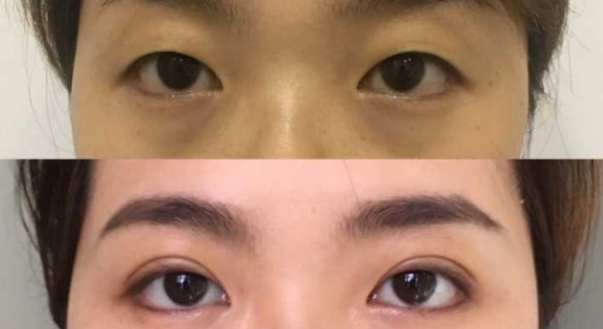 眼眶不對稱矯正 眼眶不對稱矯正