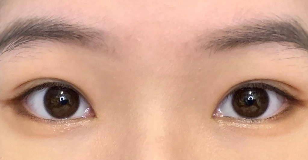 眼眶骨不對稱：成因、症狀與完整改善指南