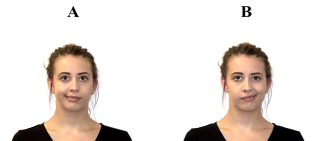 臉歪矯正 臉歪矯正