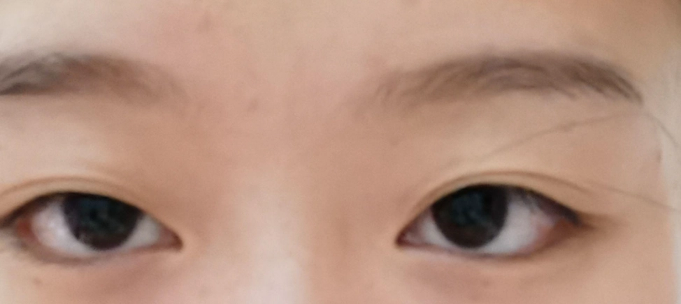 眼睛不對稱原因 眼睛不對稱原因