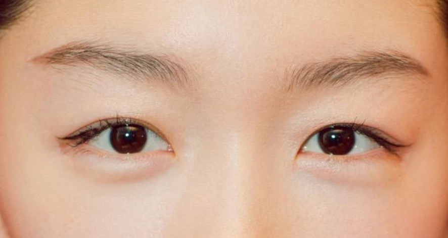 眼睛不對稱 眼睛不對稱