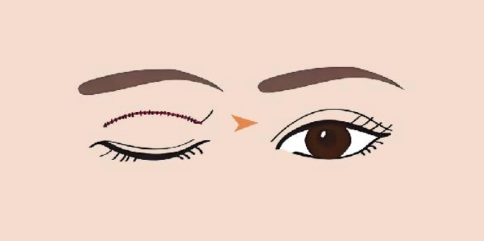 提眼肌手術後遺症 提眼肌手術後遺症