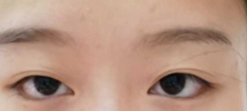 大小眼怎麼辦 大小眼怎麼辦