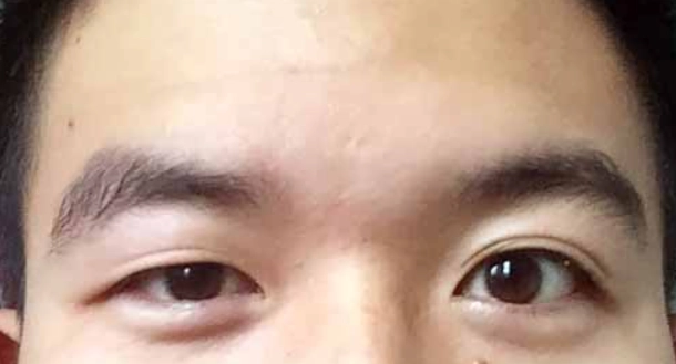 眼睛一大一小原因 眼睛一大一小原因