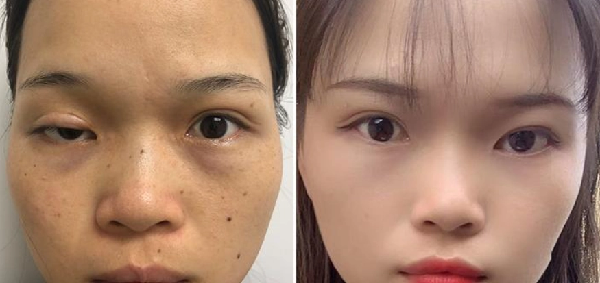 眼瞼下垂手術 眼瞼下垂手術