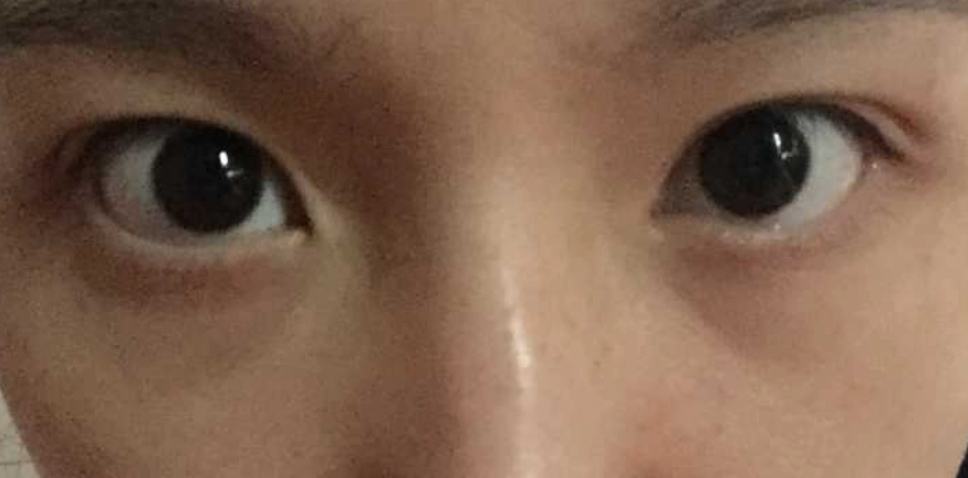 兒童眼睛大小不一 兒童眼睛大小不一