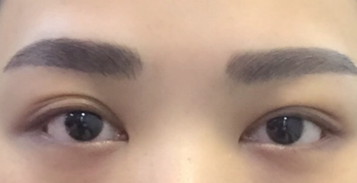 大小眼治療 大小眼治療