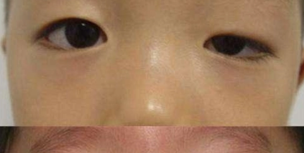 大小眼醫美矯正全解析：方法、價格、效果一次看