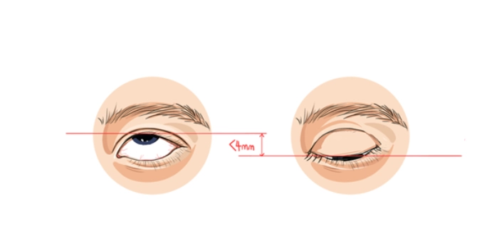 提眼肌手術恢復期注意事項