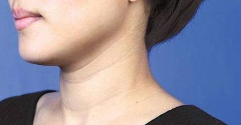 體態矯正 體態矯正