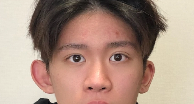 眼瞼下垂治療 眼瞼下垂治療