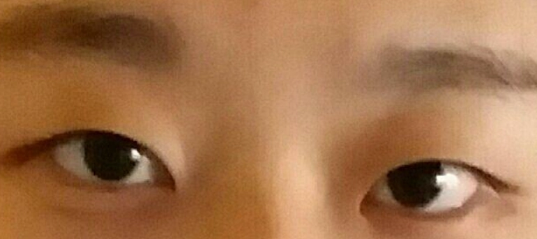 眼眶不對稱矯正 眼眶不對稱矯正