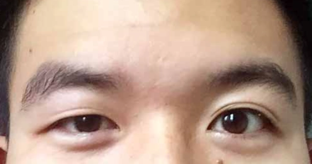 大小眼矯正 大小眼矯正