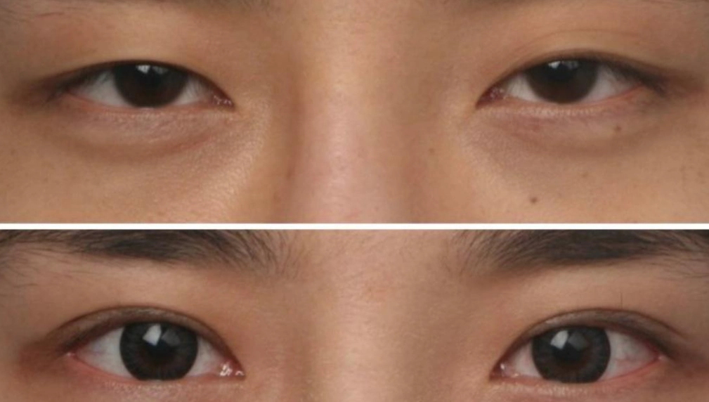 大小眼不開刀：5種自然方法改善眼睛不對稱，無需手術風險