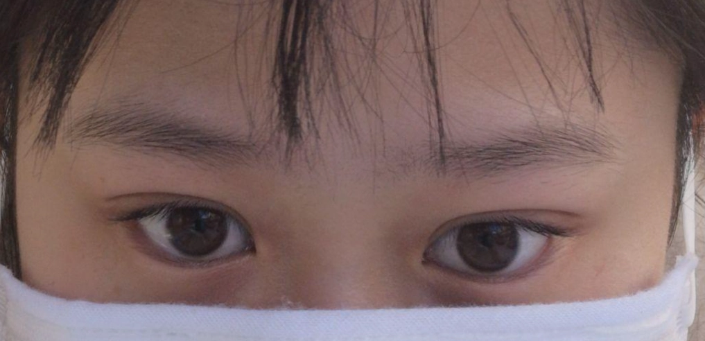 眼眶骨歪斜 眼眶骨歪斜