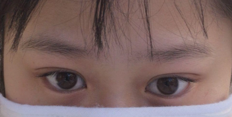 眼睛不對稱 眼睛不對稱