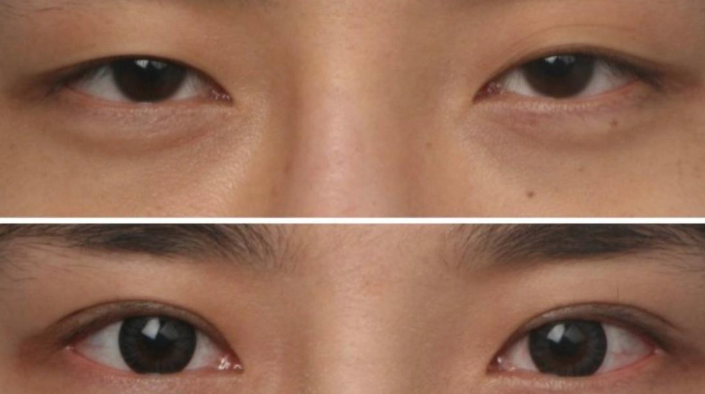 眼睛不对称 眼睛不对称