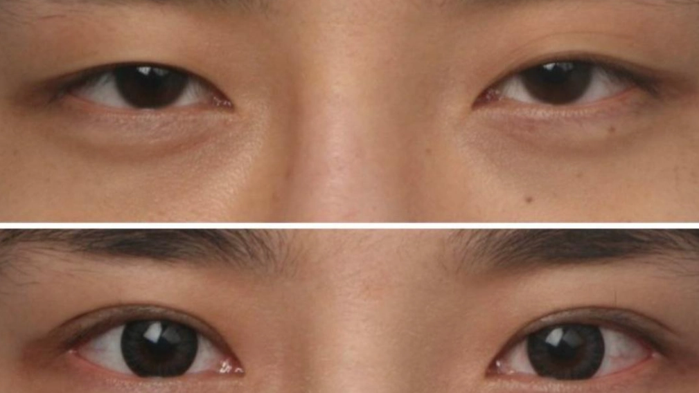 小孩大小眼怎麼辦？家長必看成因、診斷與治療全指南