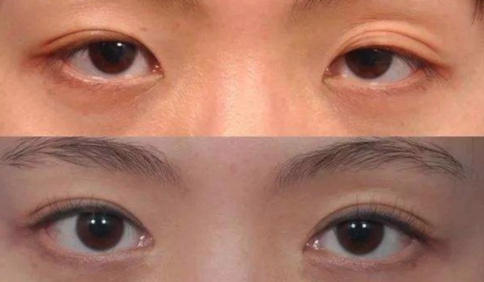 眼瞼下垂修復 眼瞼下垂修復