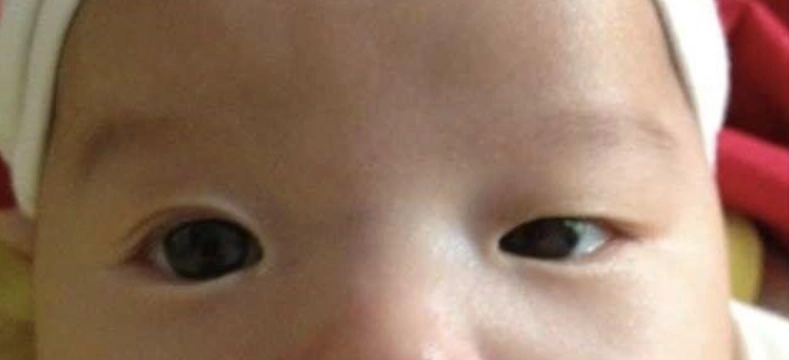 眼睛一大一小怎麼辦？專業解析原因、治療與日常改善方法