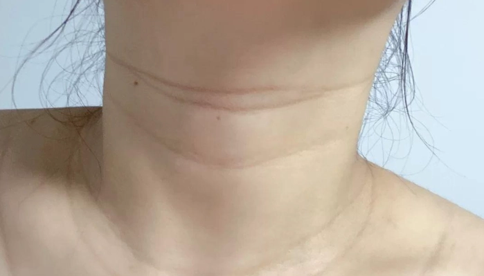 甲狀腺檢查方法 甲狀腺檢查方法