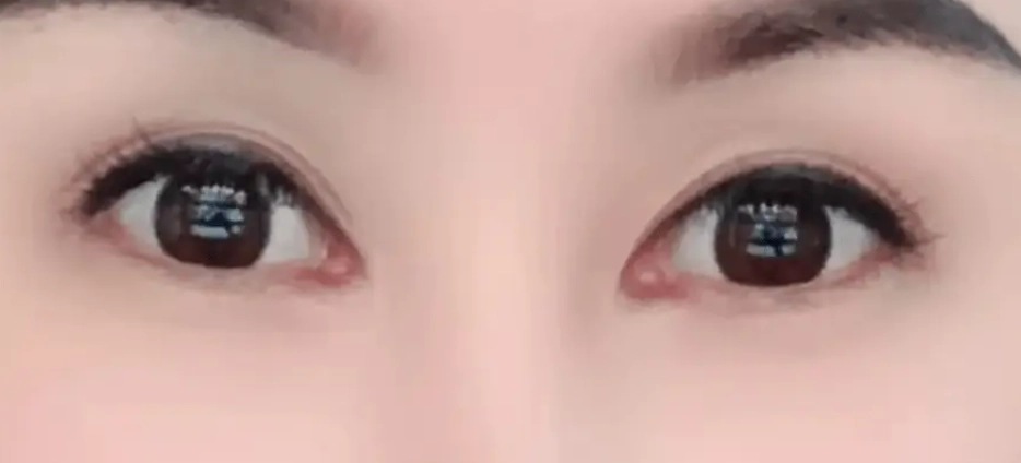 眼瞼下垂手術 眼瞼下垂手術