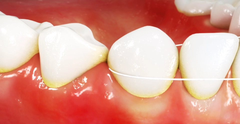 刷牙後牙線 刷牙後牙線