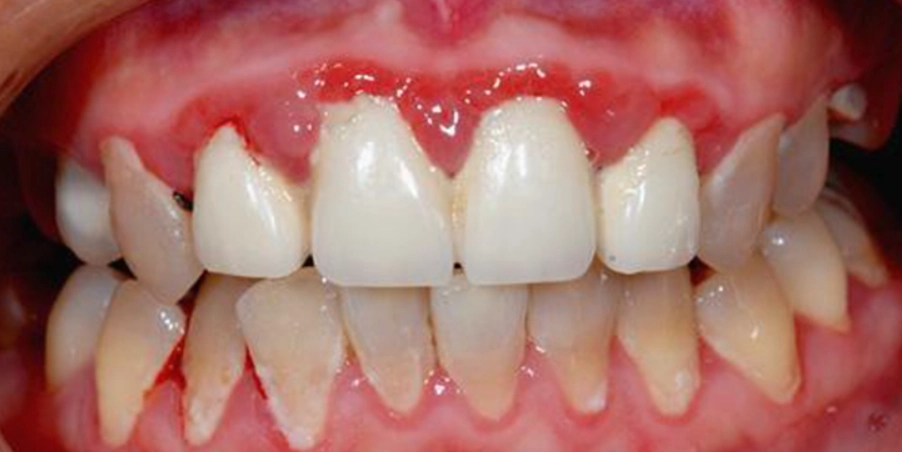 牙周病治療抗生素 牙周病治療抗生素