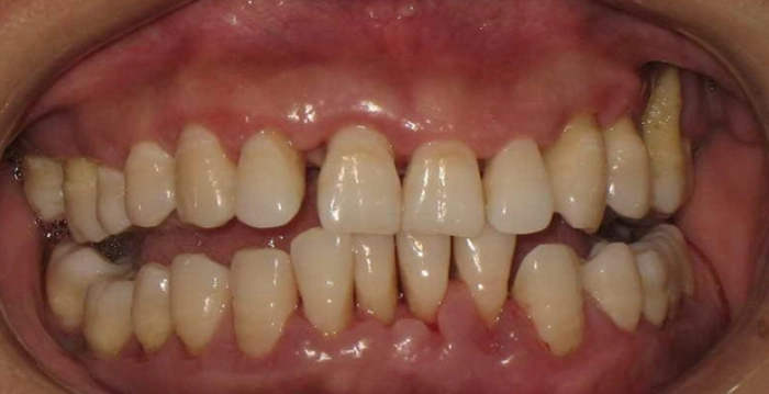 牙周病抗生素 牙周病抗生素