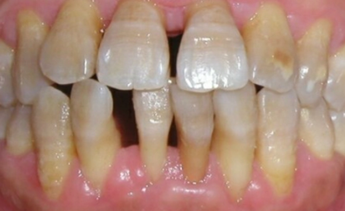 牙周病治療抗生素 牙周病治療抗生素