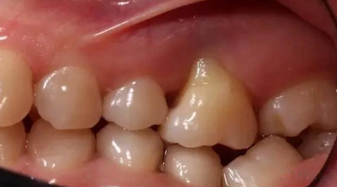 年紀大牙齦萎縮怎麼辦？預防、治療與日常護理全攻略