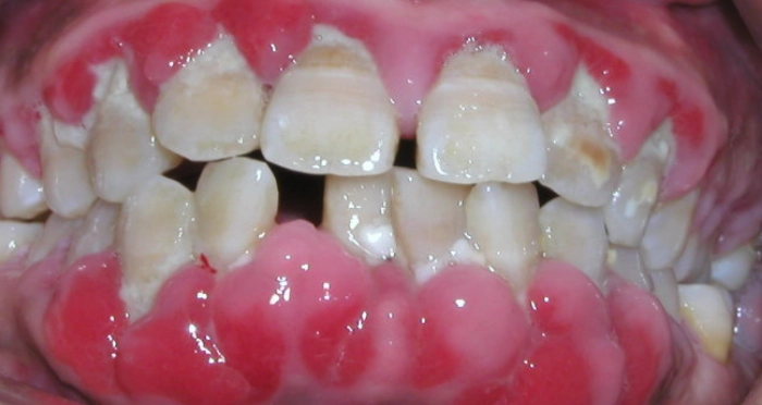 抗生素治療牙周病 抗生素治療牙周病