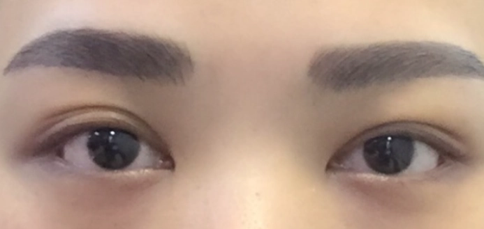 眼睛不對稱矯正 眼睛不對稱矯正