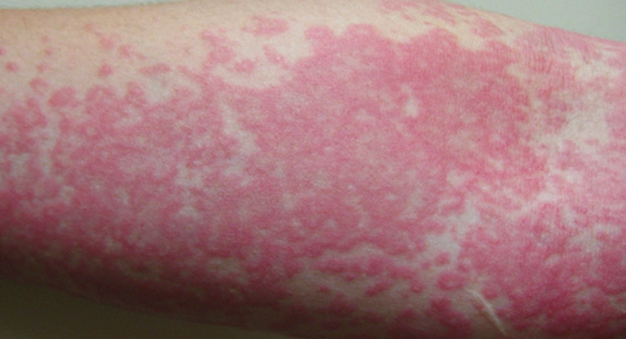 蕁麻疹原因免疫系統解析：皮膚過敏的根源與對策