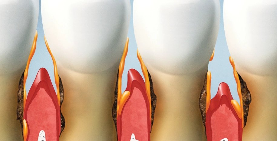 牙齦腫痛快速舒緩