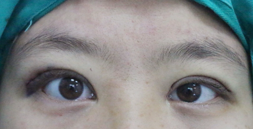 龍鳳眼大小眼原因 龍鳳眼大小眼原因