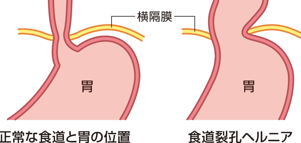 腹式呼吸如何有效緩解胃食道逆流？完整實用指南