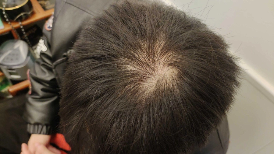 男性掉髮原因全解析：從遺傳到生活習慣的關鍵因素