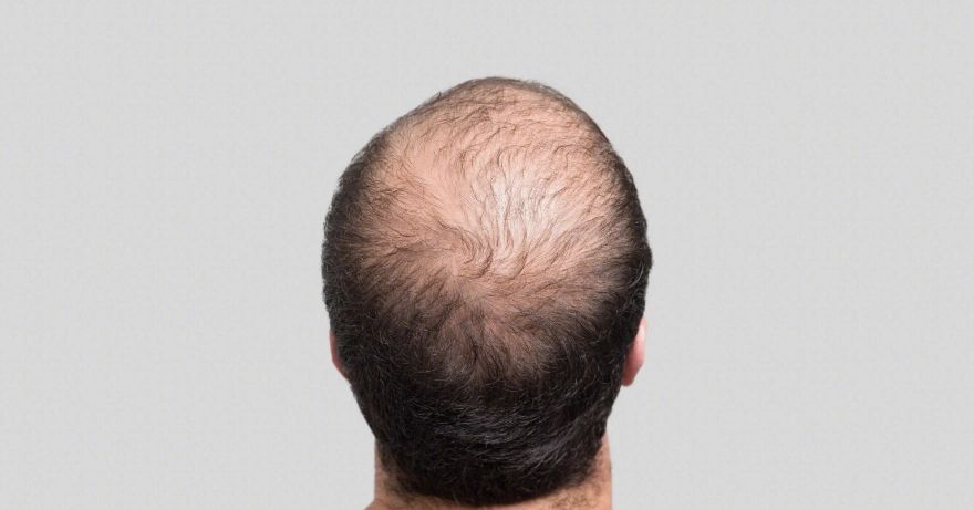 掉髮原因 掉髮原因