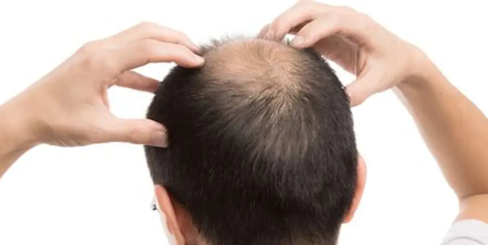 禿頭掛號科別 禿頭掛號科別