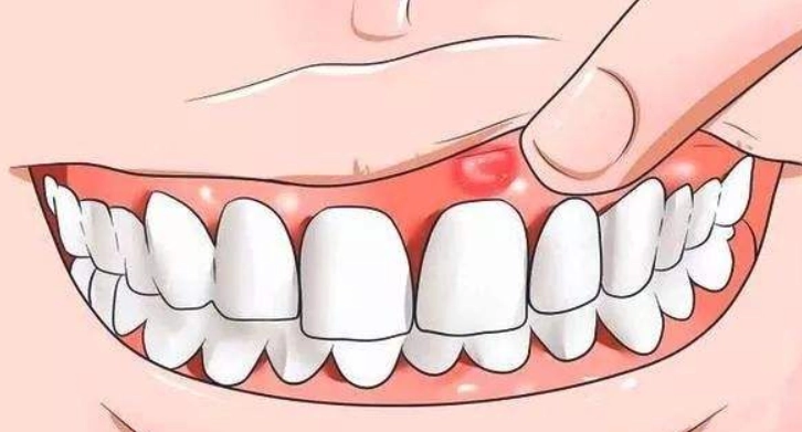 牙齦腫痛快速舒緩