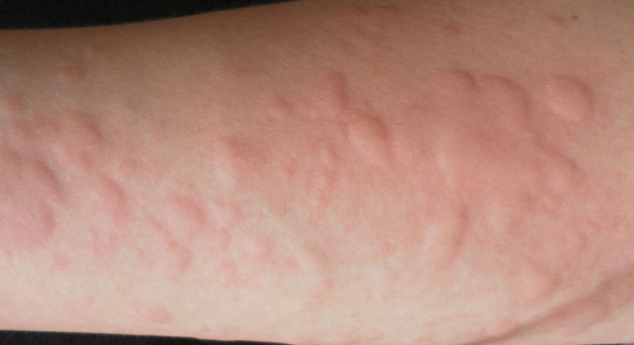 蕁麻疹治療 蕁麻疹治療