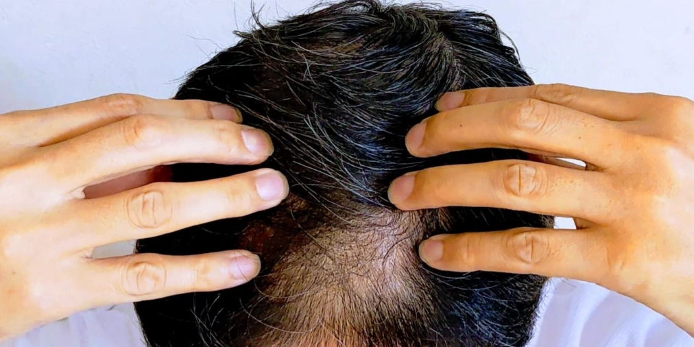 禿頭掛號科別 禿頭掛號科別