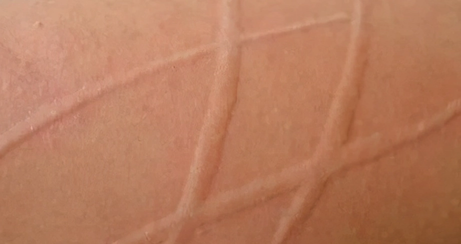 蕁麻疹治療 蕁麻疹治療