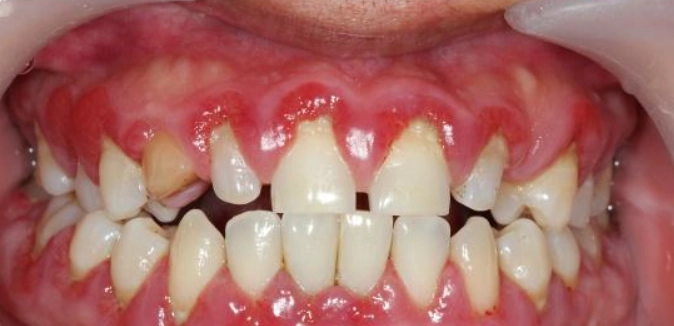 牙線棒使用不當恐致牙齦萎縮？專家教你正確清潔與預防方法