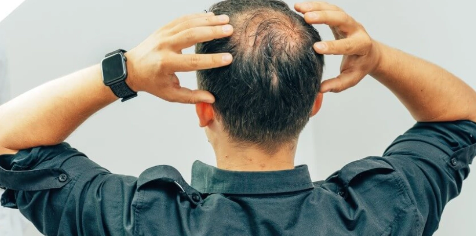 雄性禿檢查項目