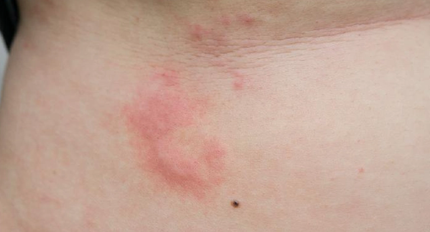 免疫系統過敏 免疫系統過敏