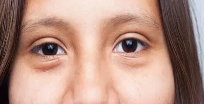 龍鳳眼大小眼原因 龍鳳眼大小眼原因