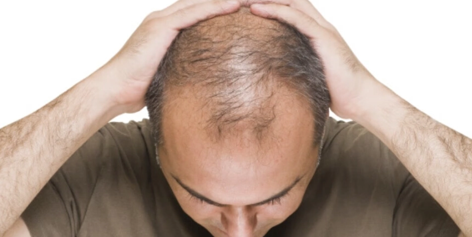 改善頭頂稀疏 改善頭頂稀疏