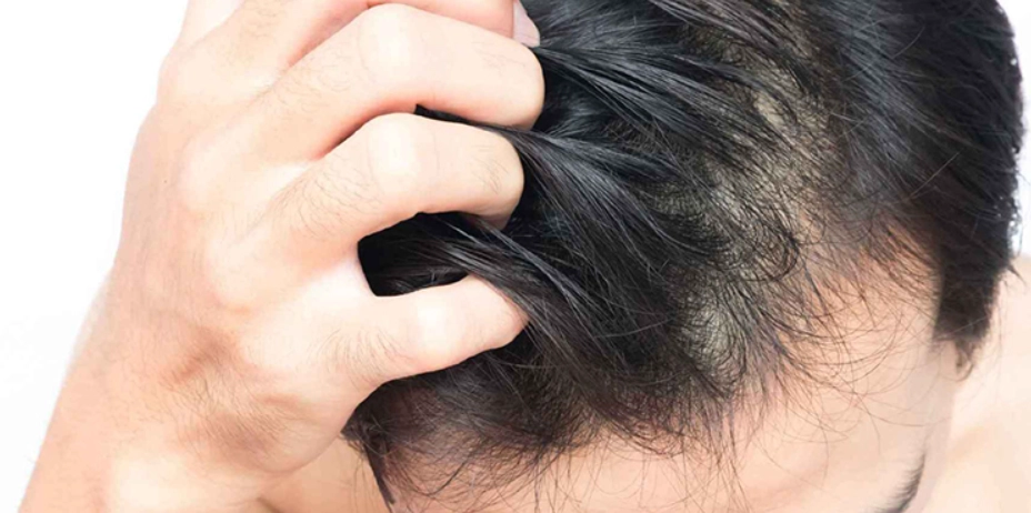 掉髮原因 掉髮原因